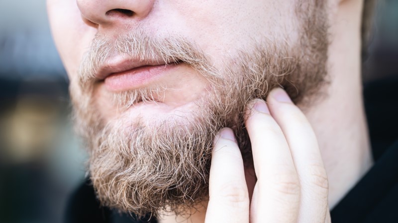 Beard Moustache Transplant