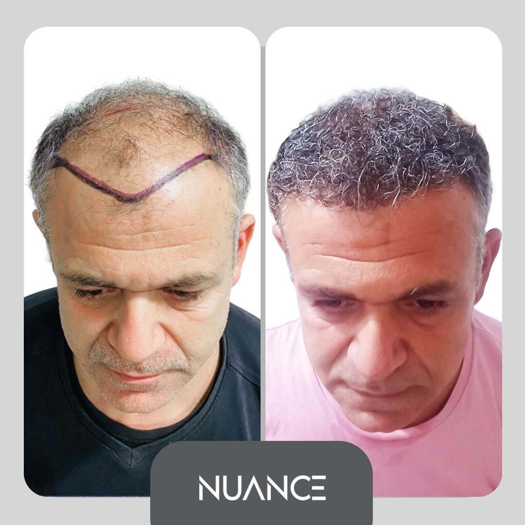 hair transplant Antalya in Turkey