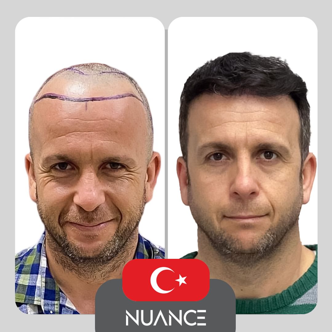 hair transplant turkey before after