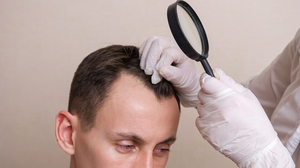 hair transplant